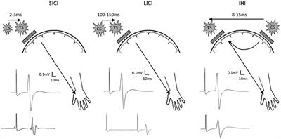 Commentary: Cooperation Not Competition: Bihemispheric tDCS and fMRI Show Role for Ipsilateral Hemisphere in Motor Learning